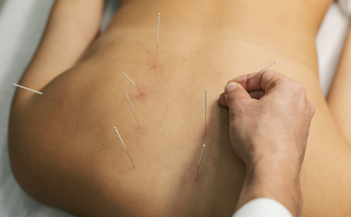 How to Make Dry Needling Part of Your Recovery Routine