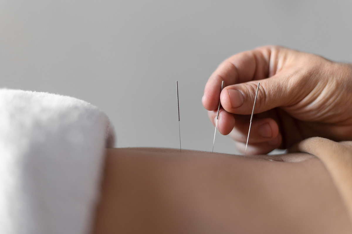 Dry Needling for Pain Relief and Muscle Function Restoration