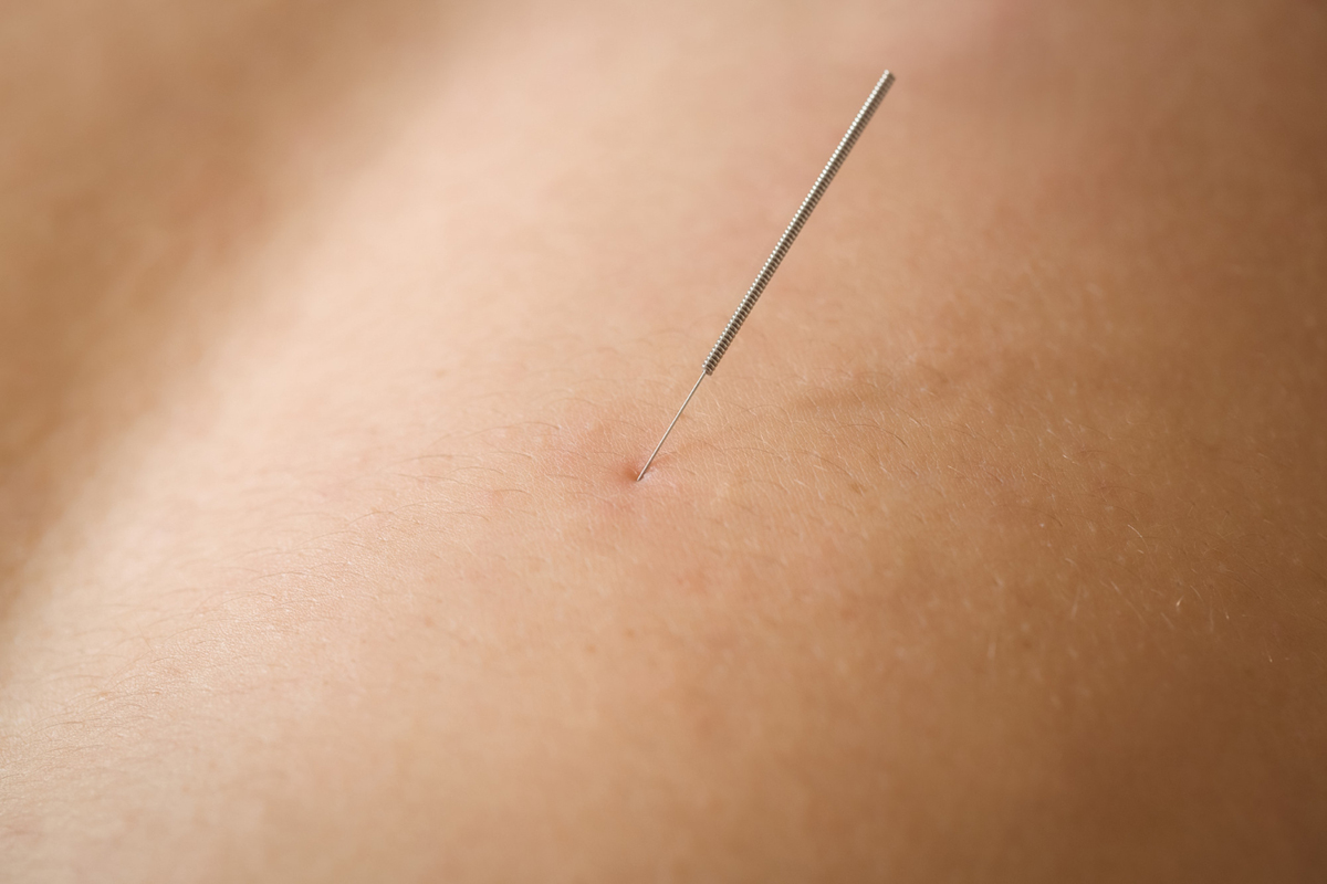 How Long Does it Take Dry Needling to Work?