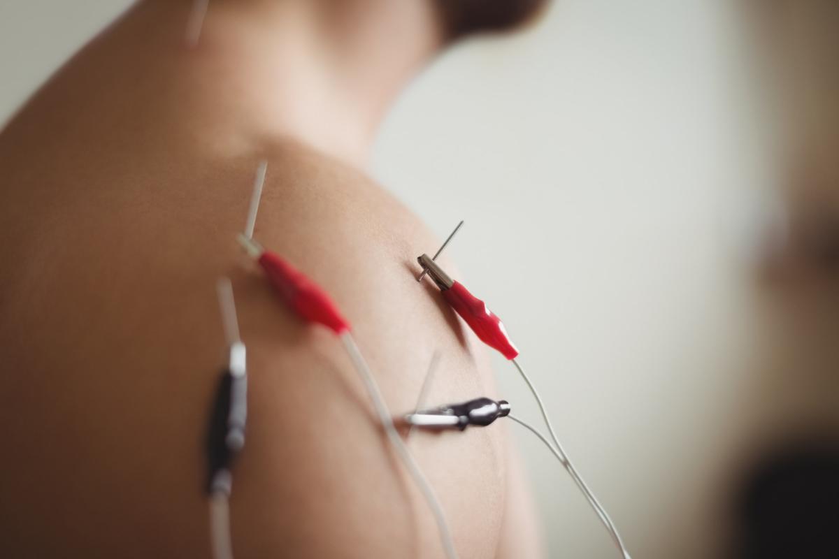Dry Needling: What Makes It Different From Acupuncture?