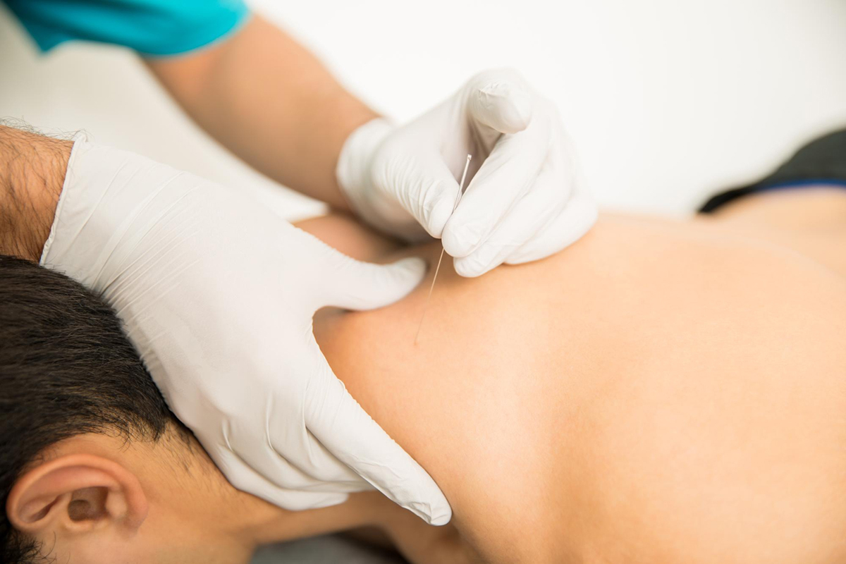 A Closer Look at Dry Needling vs Acupuncture