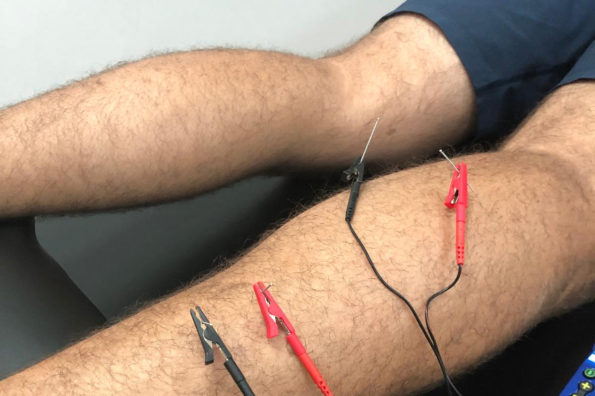 Dry Needling Therapy Benefits