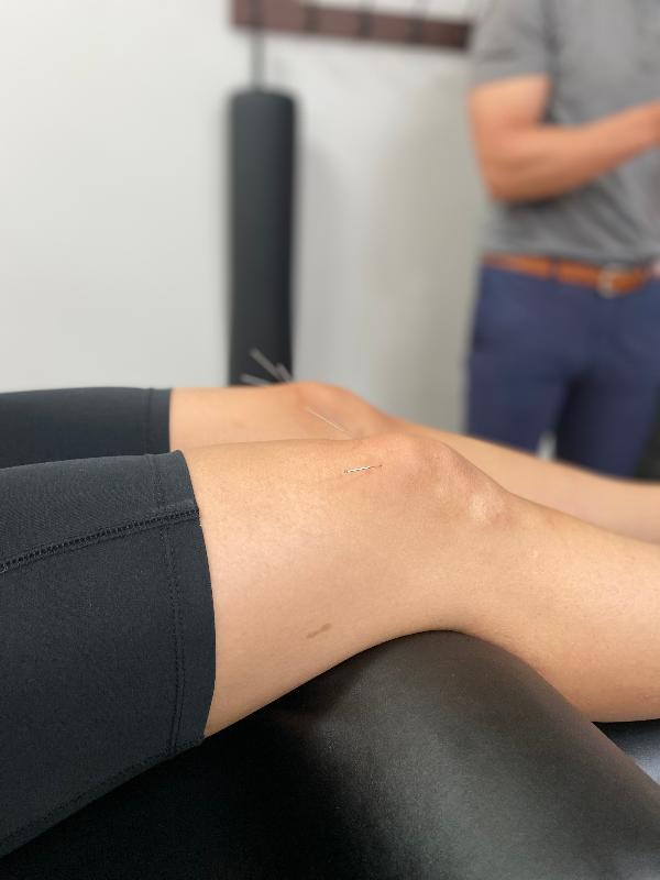 Dry needling for knee pain