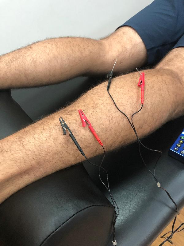 Dry needling